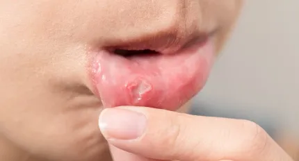 Canker Sores (Aphthous Ulcers)